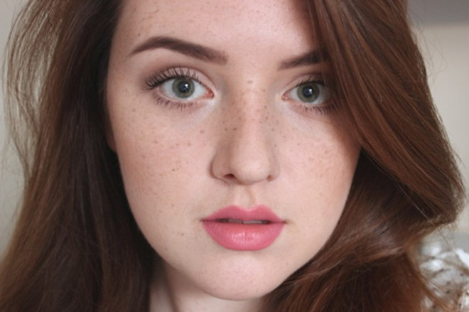 Tàn nhang - Hình ảnh minh họa